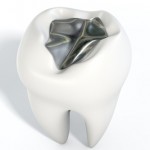 Zahnzusatzversicherung für Zahnfüllungen