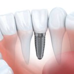 Zahnzusatzversicherung Implantate