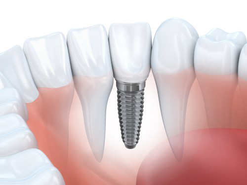 Zahnzusatzversicherung für Implantate