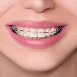 Zahnzusatzversicherung für Kieferorthopädie